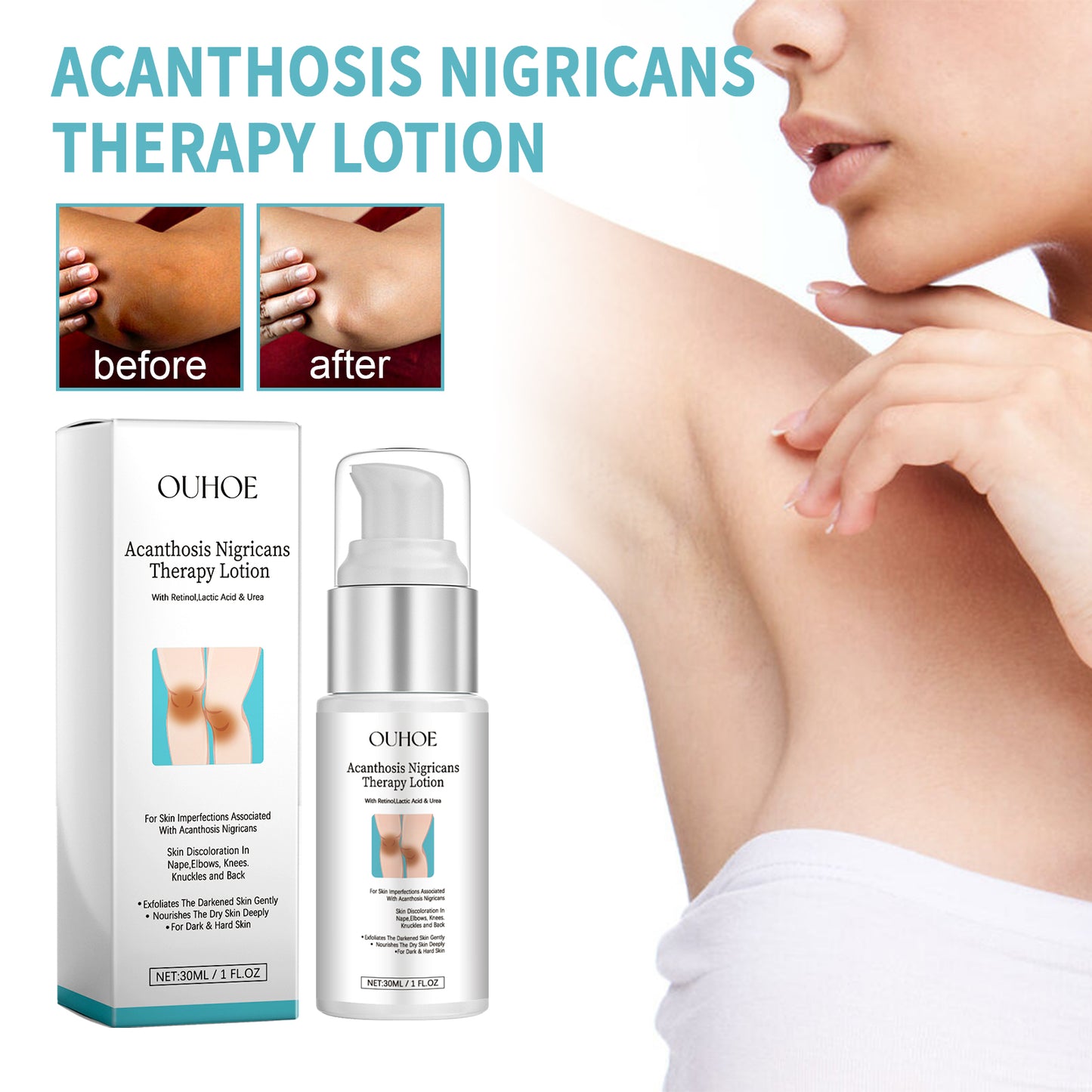 OUHOE Acanthosis Nigricans Therapy Lotion, Armpit Joint Knee Fade Melanin Deep Nourishing Whitening Skin Tender Skin