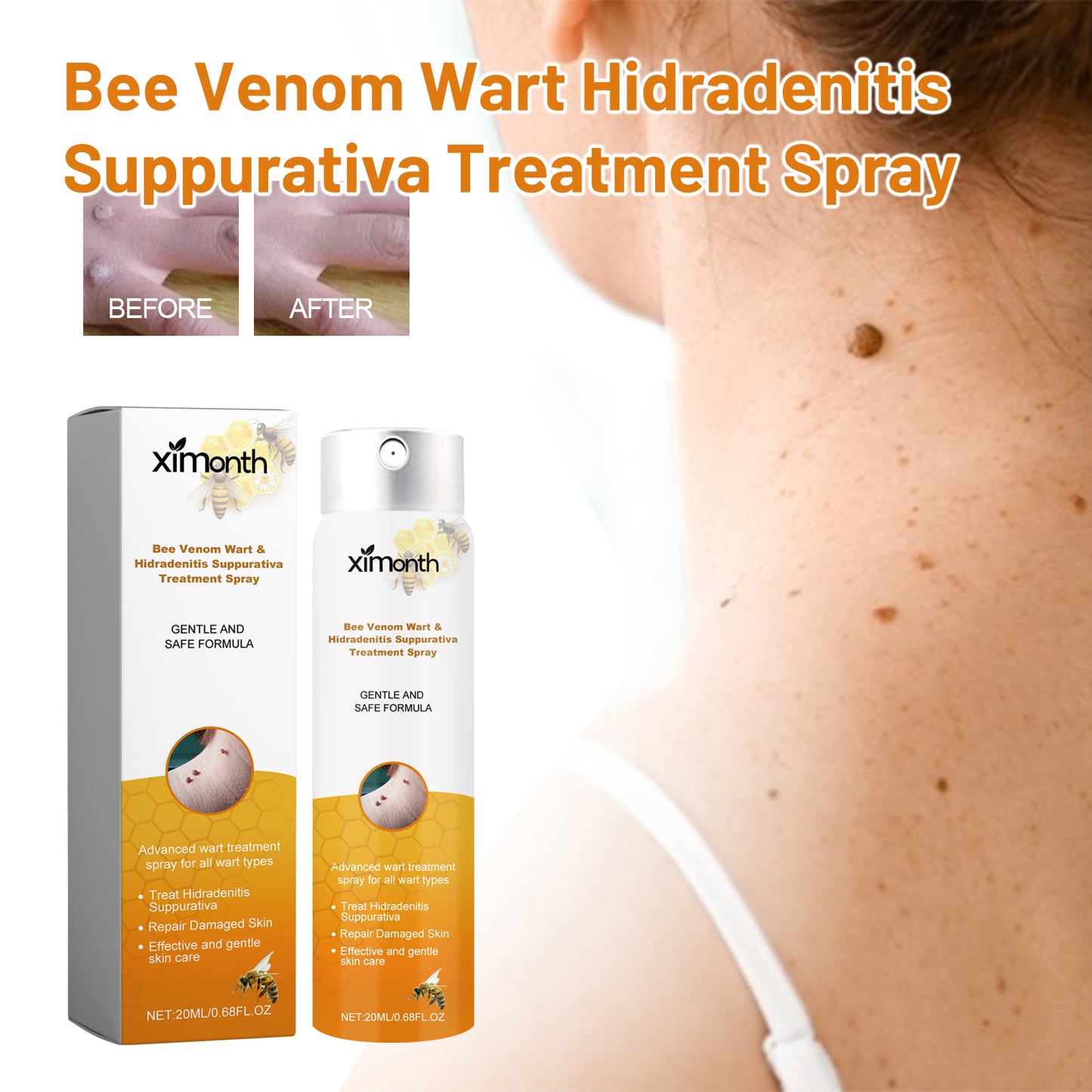 Ximonth Bee Venom Wart & Hidradenitis Suppurativa Treatment Spray, Skin Cleansing Repair Fade Moles Corns Body Care Spray